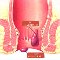 hemoroid[1]-179.jpg